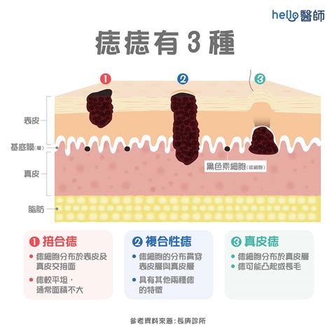 胸部長黑痣|痣形成的原因？痣長毛、痣變多變大是痣病變？5招判別